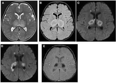 Acute Necrotizing Encephalopathy of Childhood: A Multicenter Experience in Saudi Arabia